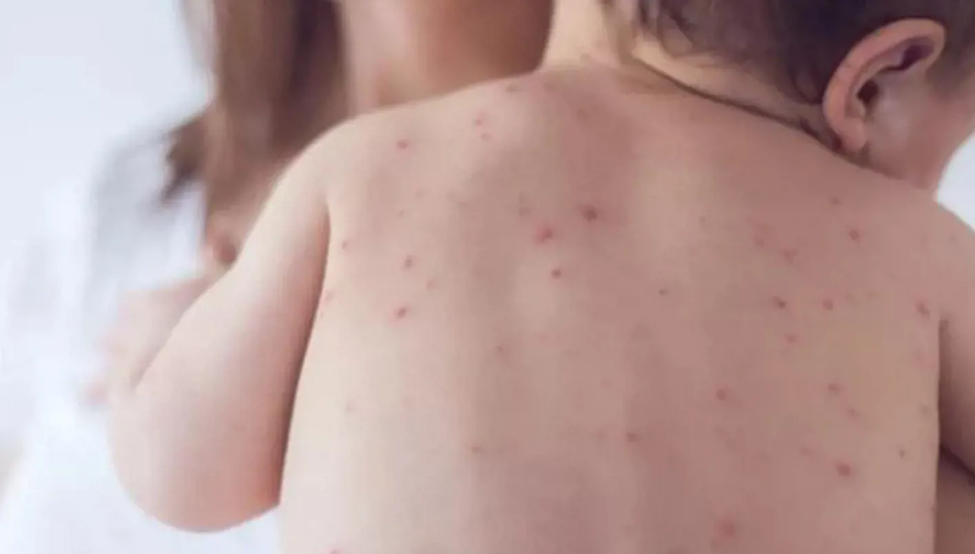 حالات الحصبة تتفشى بشكل غير مسبوق في أميركا