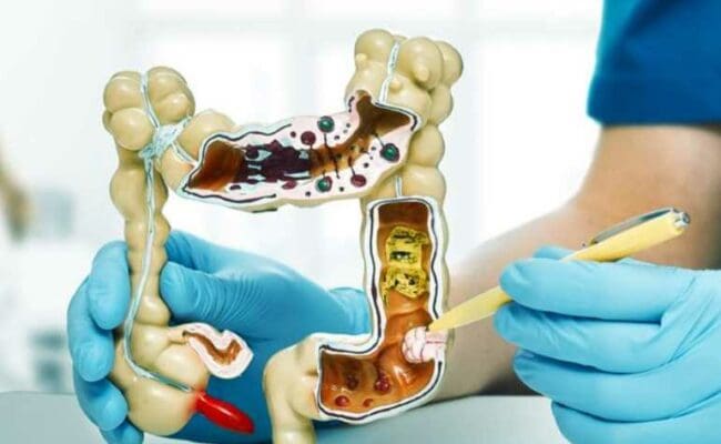 أفضل العلاجات المتاحة دون وصفة لتخفيف أعراض القولون العصبي