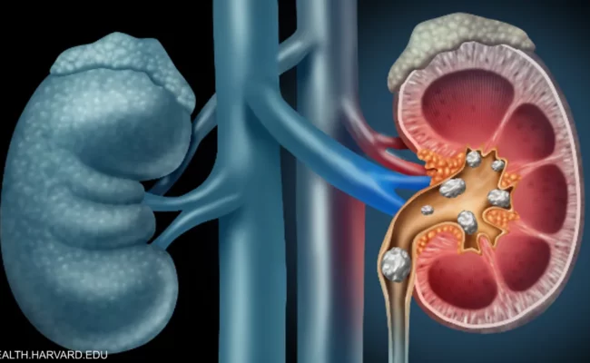 علاج ثوري لحصوات الكلى: تعديل بكتيريا الأمعاء لتفكيك الأوكسالات
