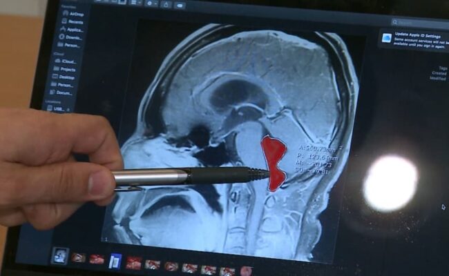 دراسة: إصابة واحدة في الرأس بعد سن الـ65 قد تزيد خطر الخرف بنسبة 70%