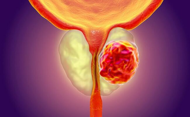 كيف يؤثر الإفراط في الألبان على التهابات البروستاتا؟