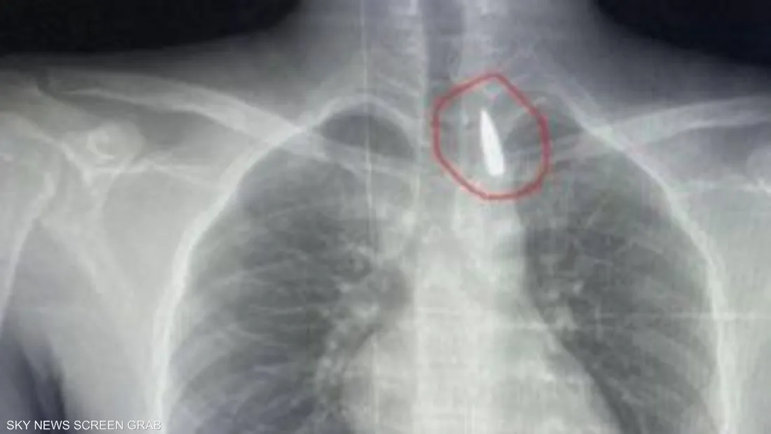 جراحون مصريون يستخرجون مقذوفاً من قرب الشريان الأورطي لإنقاذ مصاب فلسطيني