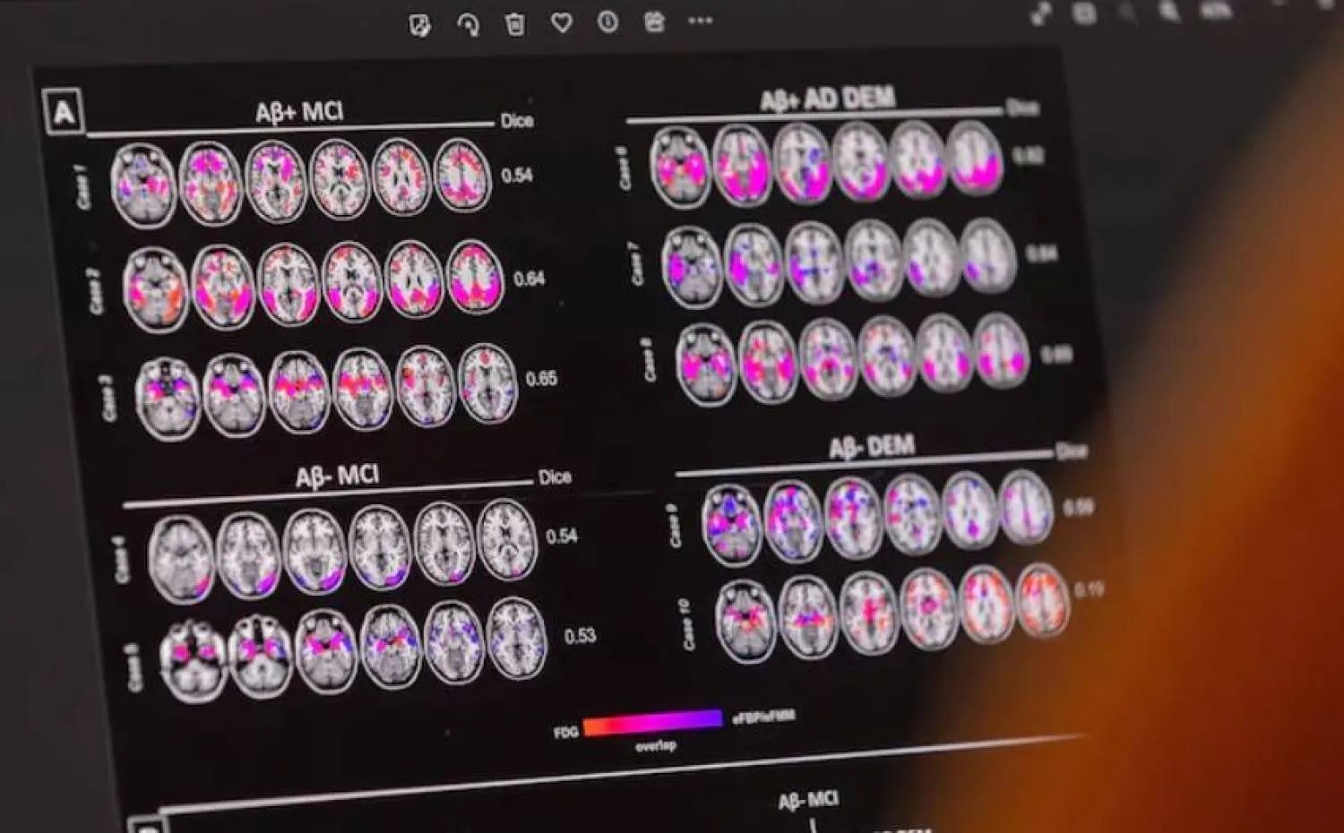 الموسيقى درع ذهني ضد الخرف
