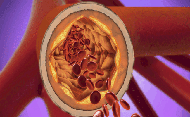 دواء جديد يحقق خفضاً قياسياً في مستويات الكوليسترول الضار