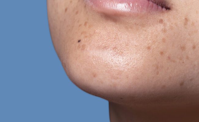 أفضل المكونات لعلاج البقع الداكنة واستعادة إشراق البشرة في فصل الخريف