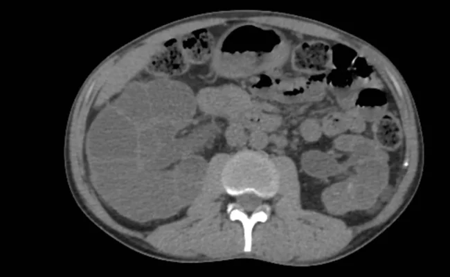 علماء في برلين يحققون تقدماً باستخدام "تحرير القاعدة" لتصحيح طفرات مرض الكلى متعدد الكيسات