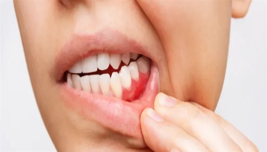 سرطان الفم... خطر صامت يتغذى على الإهمال اليومي لا على التبغ وحده