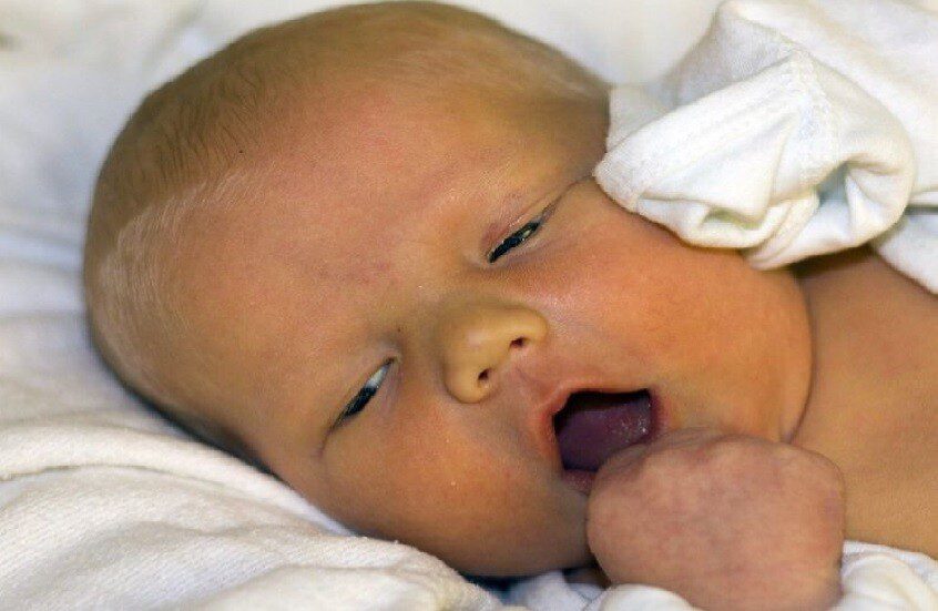 اليرقان… أسبابه الخفية ومضاعفاته الصحية الخطيرة