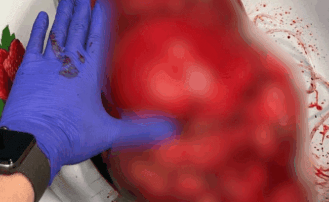 أطباء روس ينجحون في استئصال ورم عملاق يزن نحو 2 كلغ من امرأة ستينية