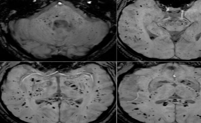 دراسة أسترالية: كوفيد-19 يخلّف آثارًا مستمرة على الدماغ حتى بعد التعافي