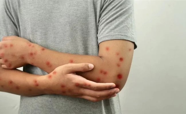 الصحة العالمية: تراجع الوفيات بسبب الحصبة خلال الـ 25 عاماً الأخيرة