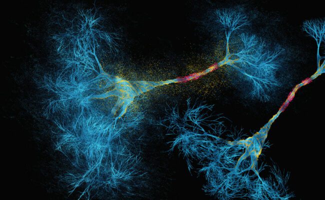 الذكاء الاصطناعي يعيد تشكيل فهم التصلب المتعدد
