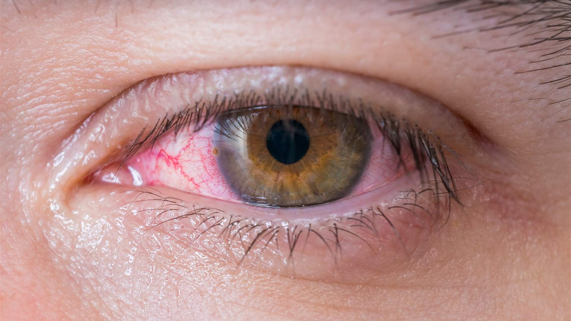 مكان غير متوقع لسرطان الجلد الميلانيني: العين والجفون أيضاً معرضتان