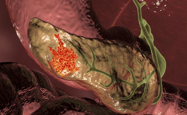 تجربة دوائية جديدة تفتح الباب أمام اختفاء دائم لسرطان البنكرياس