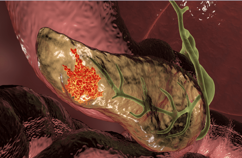 تجربة دوائية جديدة تفتح الباب أمام اختفاء دائم لسرطان البنكرياس