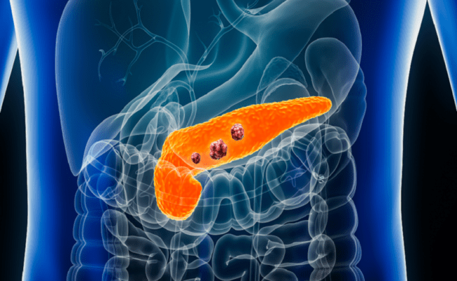 اختبار دم مبتكر يفتح باب الأمل للكشف المبكر عن سرطان البنكرياس