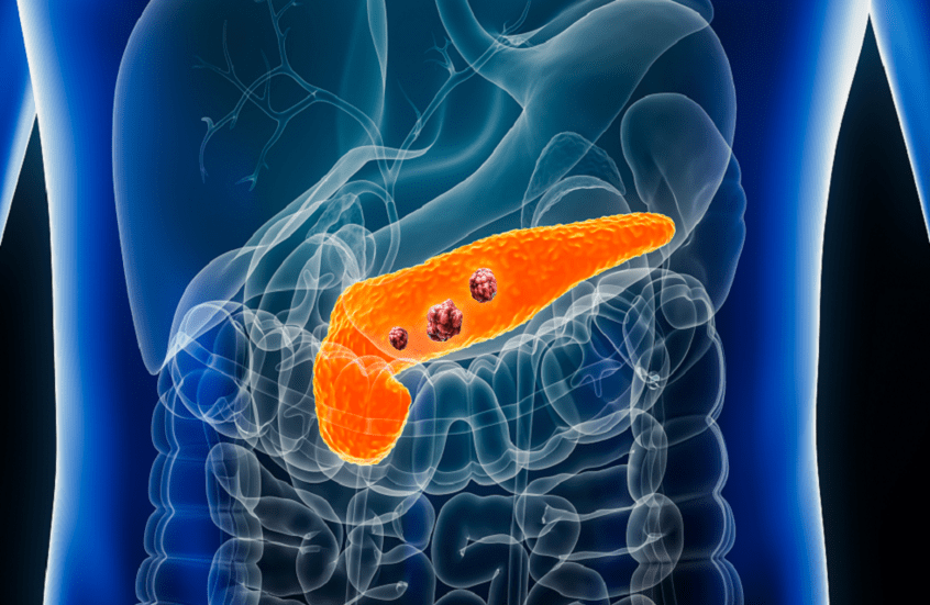 اختبار دم مبتكر يفتح باب الأمل للكشف المبكر عن سرطان البنكرياس