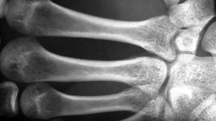 أدوية هشاشة العظام قد تحمي الدماغ وتخفض خطر الخرف لدى كبار السن