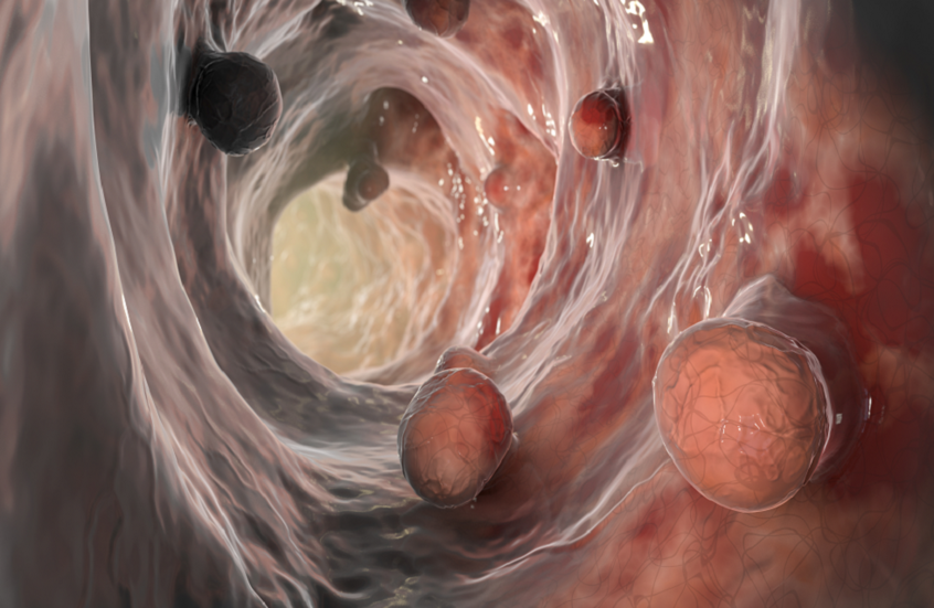 تعبيرية عن سرطان الأمعاء