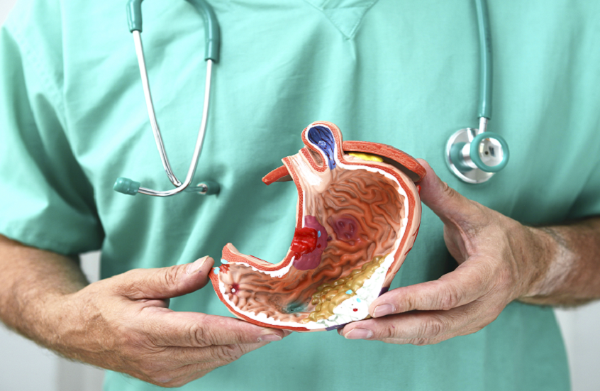 تعبيرية عن سرطان المعدة