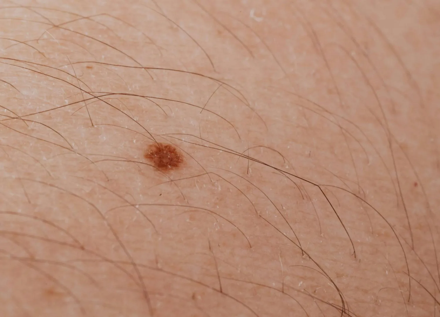 توقعات بانخفاض في خطر الإصابة بسرطان الجلد بعد الانخفاض في عدد الشامات التي يصاب بها الأطفال