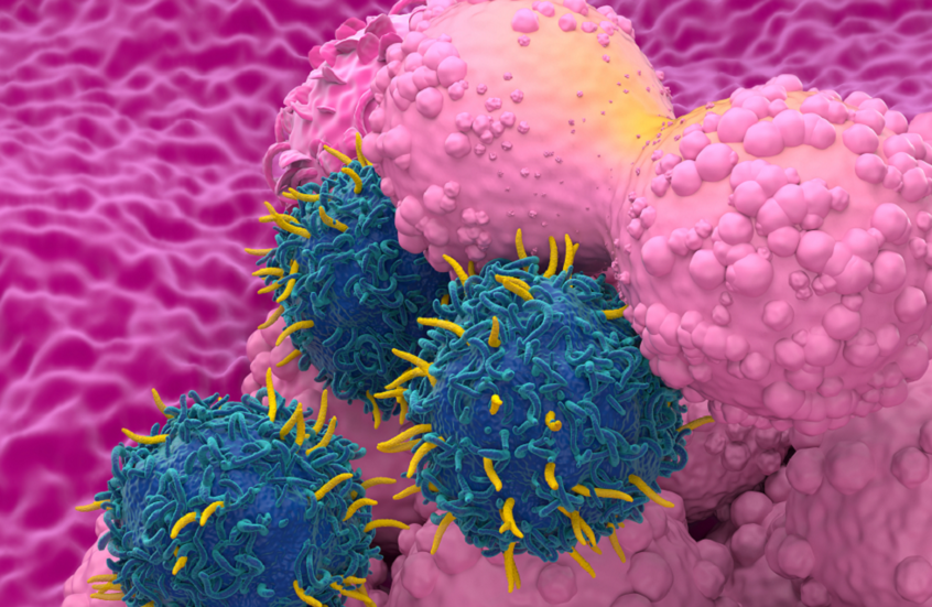 سرطان الثدي