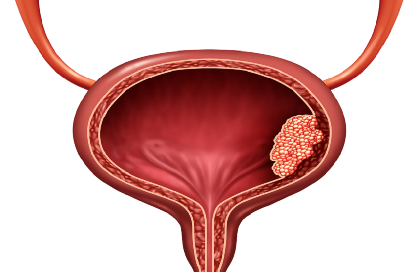 سرطان المثانة