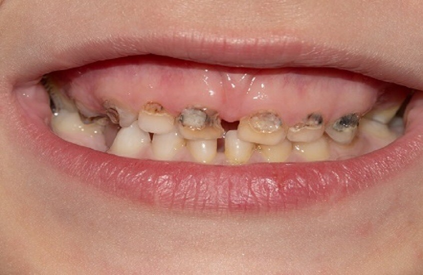 تسوس الأسنان