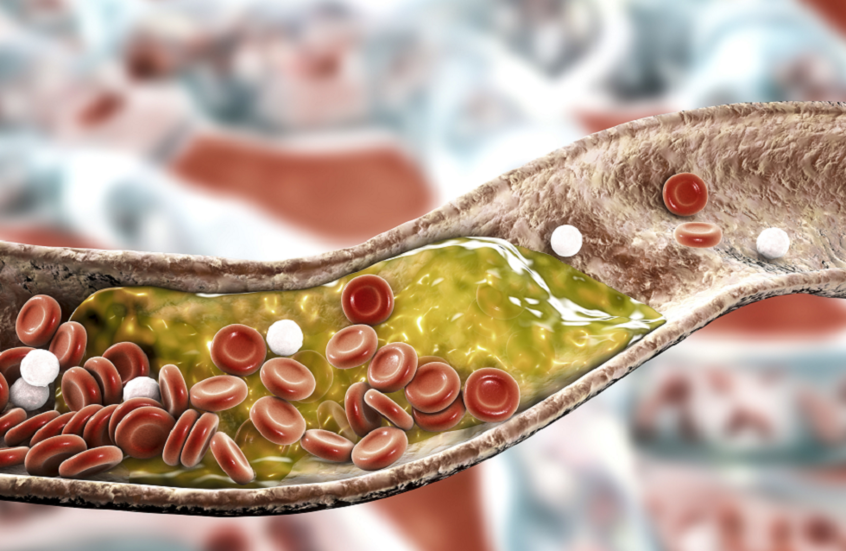 تعبيرية عن الكولسترول