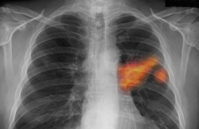 دراسة تكشف رابطًا بيولوجيًا بين “كوفيد-19” وسرطان الرئة